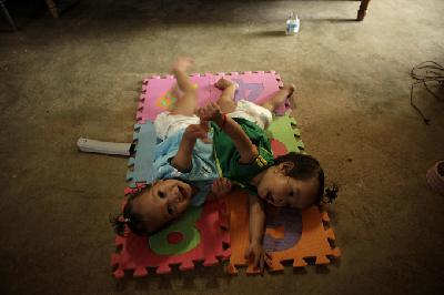 В Панаме разделят годовалых сиамских близняшек