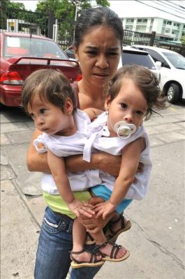 В Панаме провели операцию по разделению сиамских близняшек